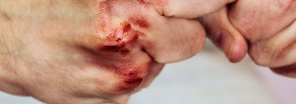 what-is-felony-assault-in-myrtle-beach
